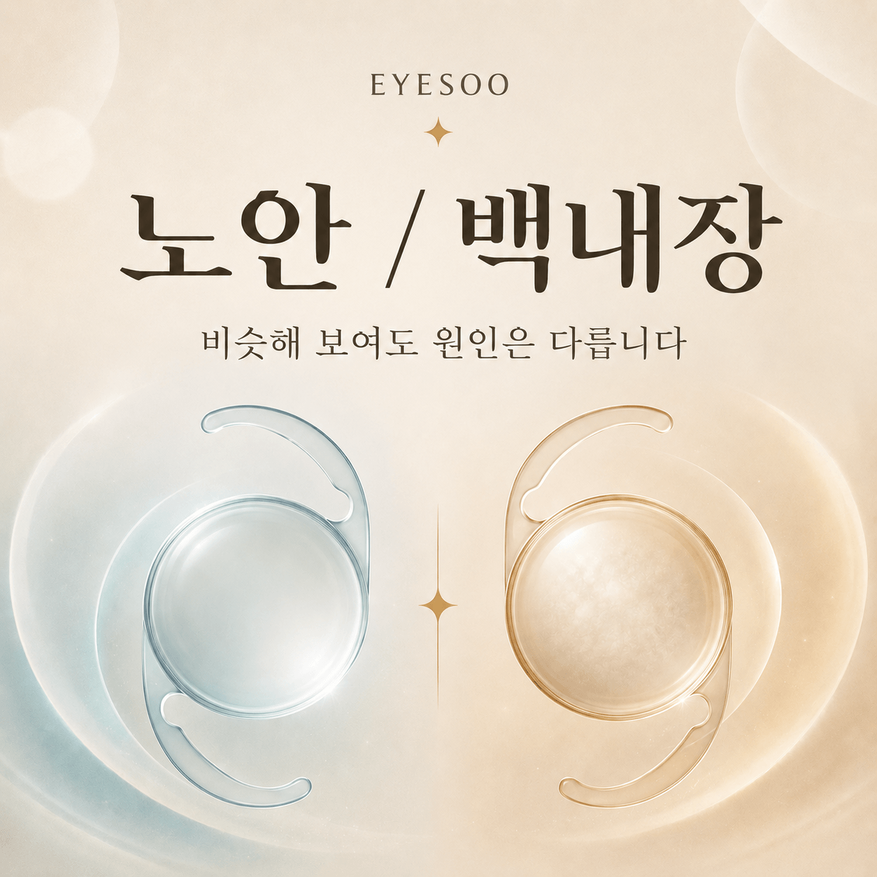노안 백내장