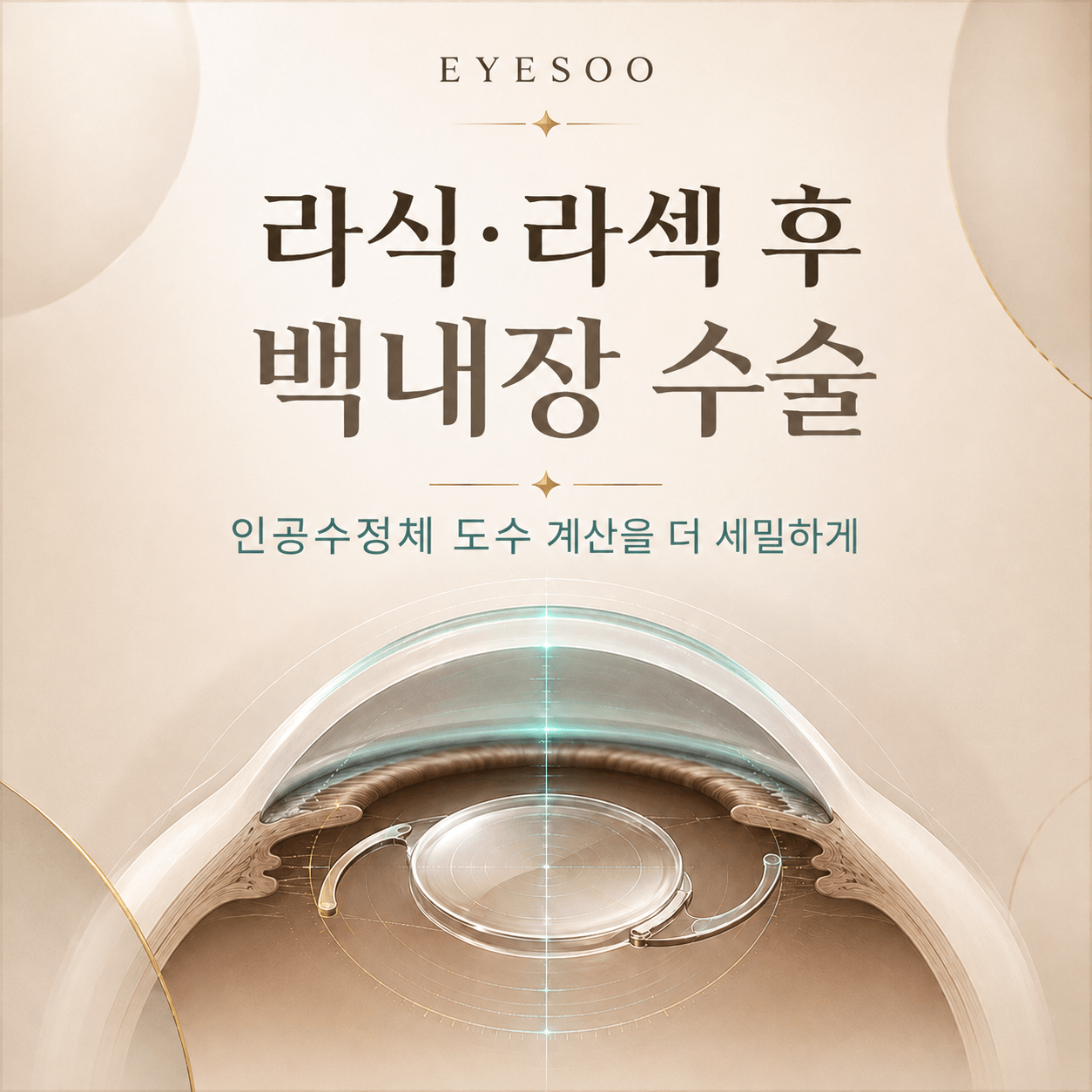 라식 라섹 후 백내장 수술